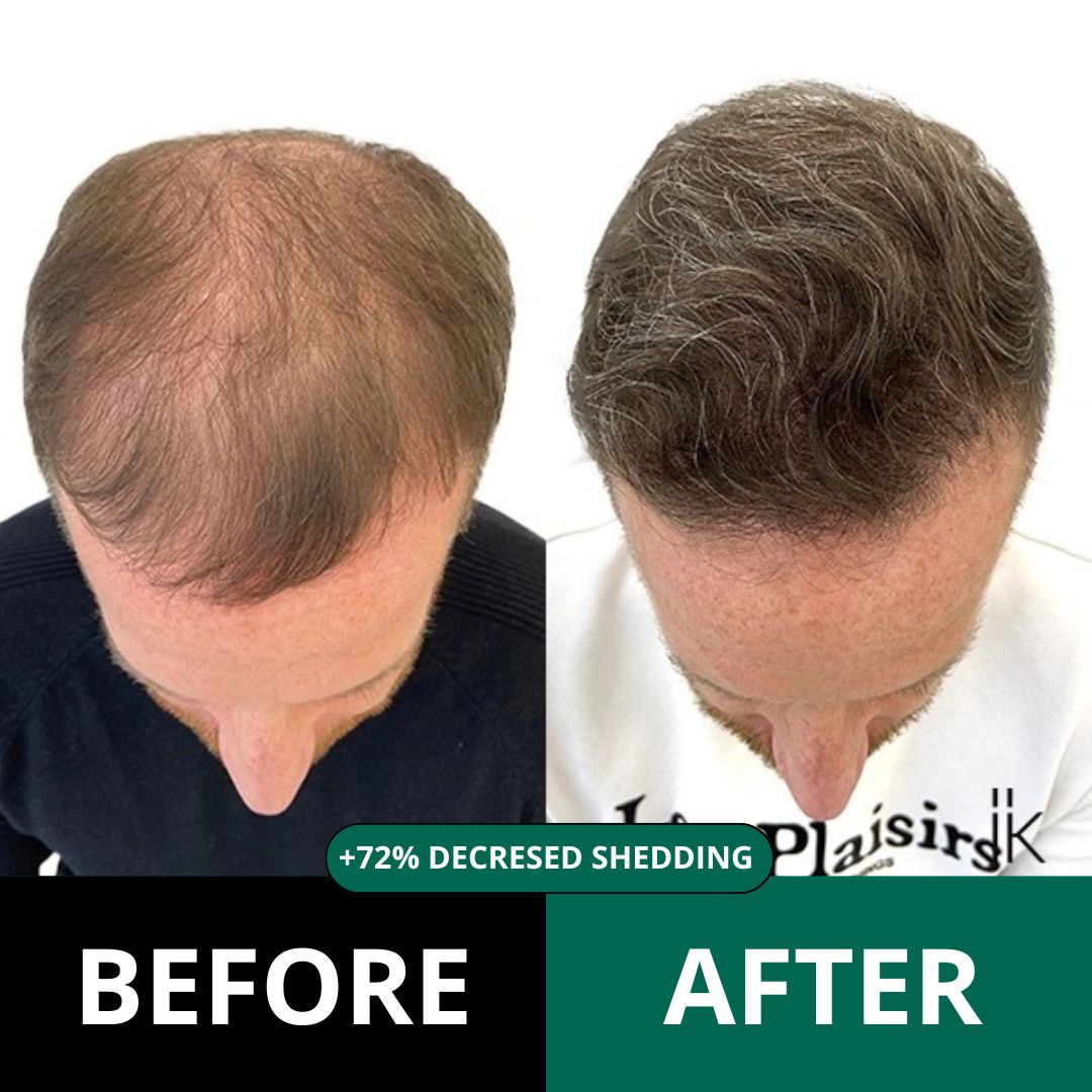 Revive™ - Hair Regrowth system