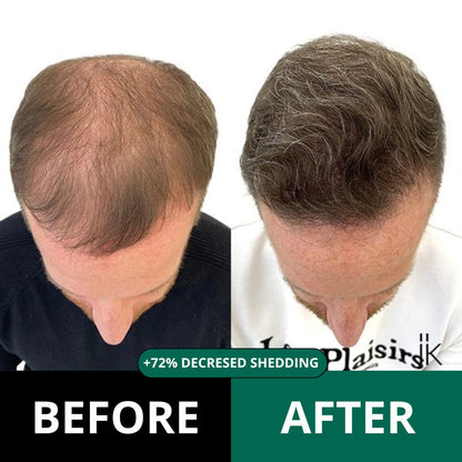 Revive™ - Hair Regrowth system