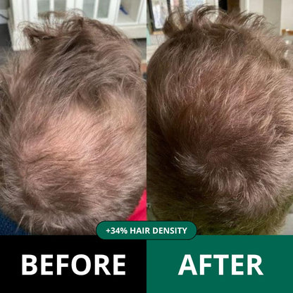 Revive™ - Hair Regrowth system